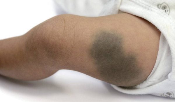 وحمة البقع المنغولية