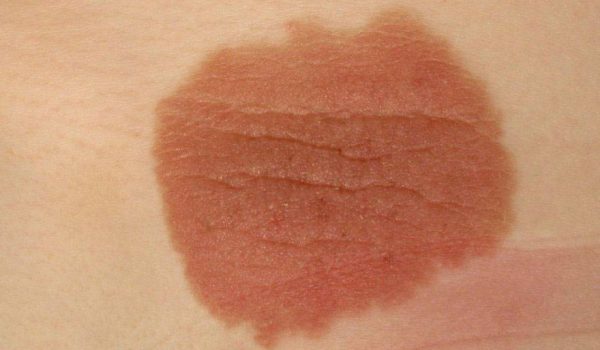 الوحمة أو الشامة الخلقية