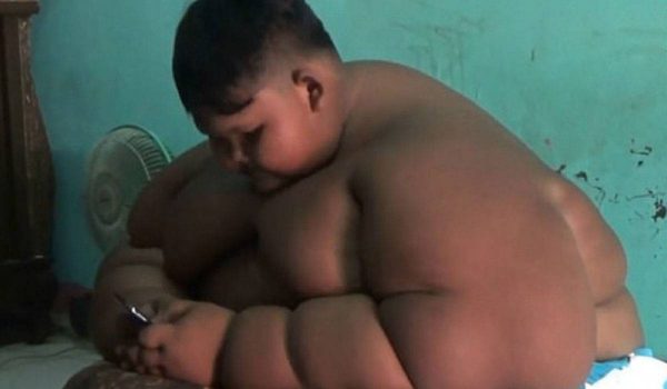 تقليص المعدة