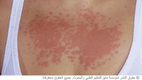 الطفح الضوئي الطفح الضوئي