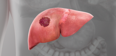 f5d5ba53d0f5a97d0f5731a7fef3013d-1 إطلالة على واقع السرطان الكبدي الخلوي