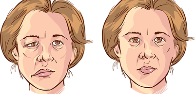 fec02d496eb70bbc16e15d2d26d56a94-1 شلل الوجه النصفي يتسبب بضعف مفاجئ لعضلات الوجه