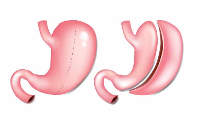gastroplastika-1200x800-825x510-2 تكميم المعدة