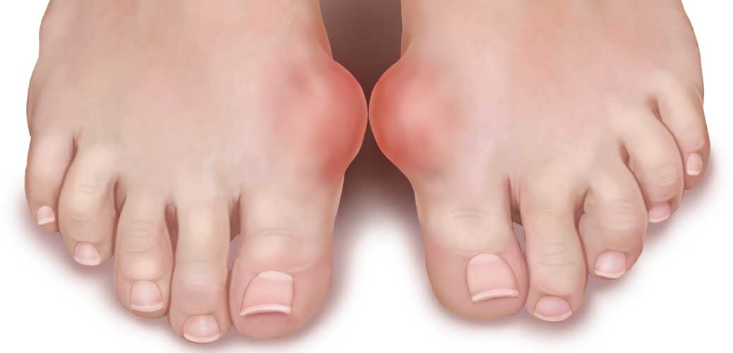 النقرس  (داء الملوك ) – أعراضه، اسبابه وعلاجه بالطرق الطبيعية