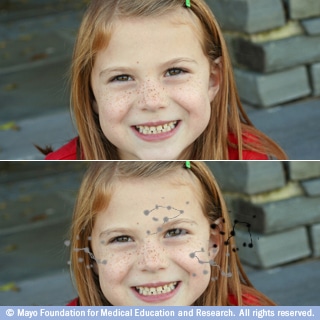 الإبصار مع البقع العائمة الإبصار مع البقع العائمة