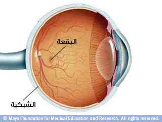 التنكس البقعي التنكس البقعي