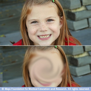 الإبصار في التنكس البقعي الإبصار في التنكس البقعي