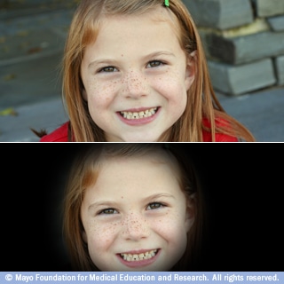 الإبصار لدى الذين يعانون من زرق العين الإبصار لدى الذين يعانون من زرق العين