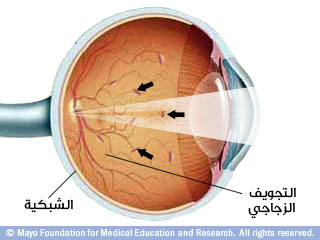 البقع العائمة البقع العائمة