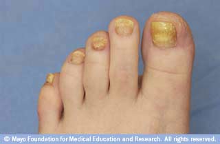 الأظافر السميكة: ما الذي يسببها؟ الأظافر السميكة: ما الذي يسببها؟