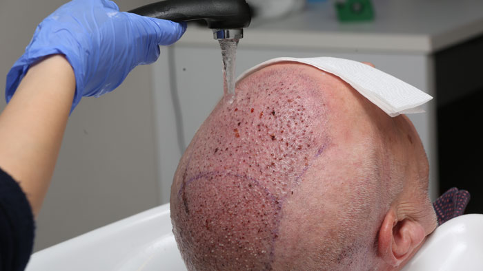 hair-transplant-1-3 طبابة نت - الدليل الكامل لزراعة الشعر