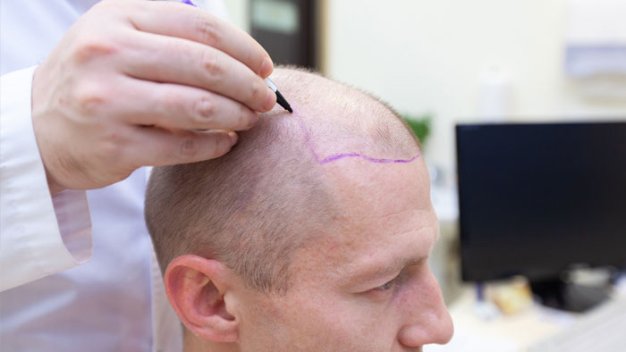 hair-transplant-2 طبابة نت - زراعة الشعر