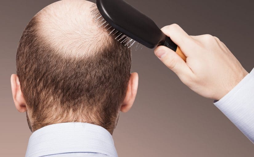 hair-transplant-spot-21-825x510-2 زراعة الشعر في مصر