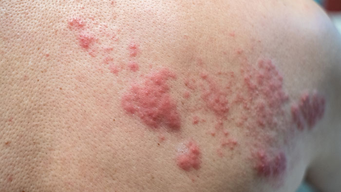 herpes-1-2 طبابة نت - 6 أعراض من أعراض الإصابة بمرض “الهربس