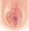 hymen-cribriform الغشاء الغربالي