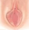 hymen-imperforate أنواع غشاء البكارة - الغشاء المصمت
