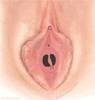 hymen-septate أنواع غشاء البكارة - المزدوج الفتحات