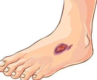 image-12 اعراض السكري