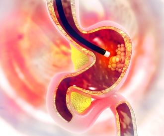 تشخيص قرحة المعدة