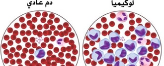 in-the-text330x1345 لوكيميا