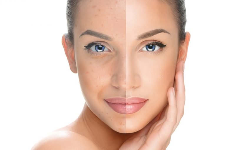 inside-out-skin-remodeling-825x510-2 علاج تصبغات البشرة