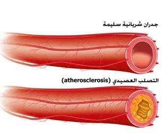 صورة لشرايين مصابة بالتصلب العصيدي مضاعفات الكوليسترول