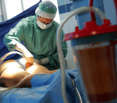 liposuction-2-380x335-1 15.شفط الدهون :