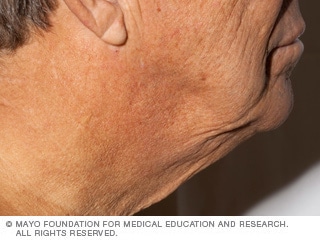 المران الشمسي المران الشمسي