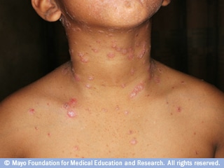 صدفية النقاط صدفية النقاط