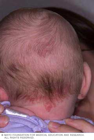 صدفية الأظافر صدفية الأظافر