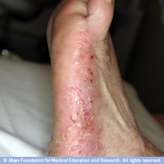 الصدفية البثرية الصدفية البثرية