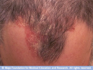 صدفية فروة الرأس صدفية فروة الرأس