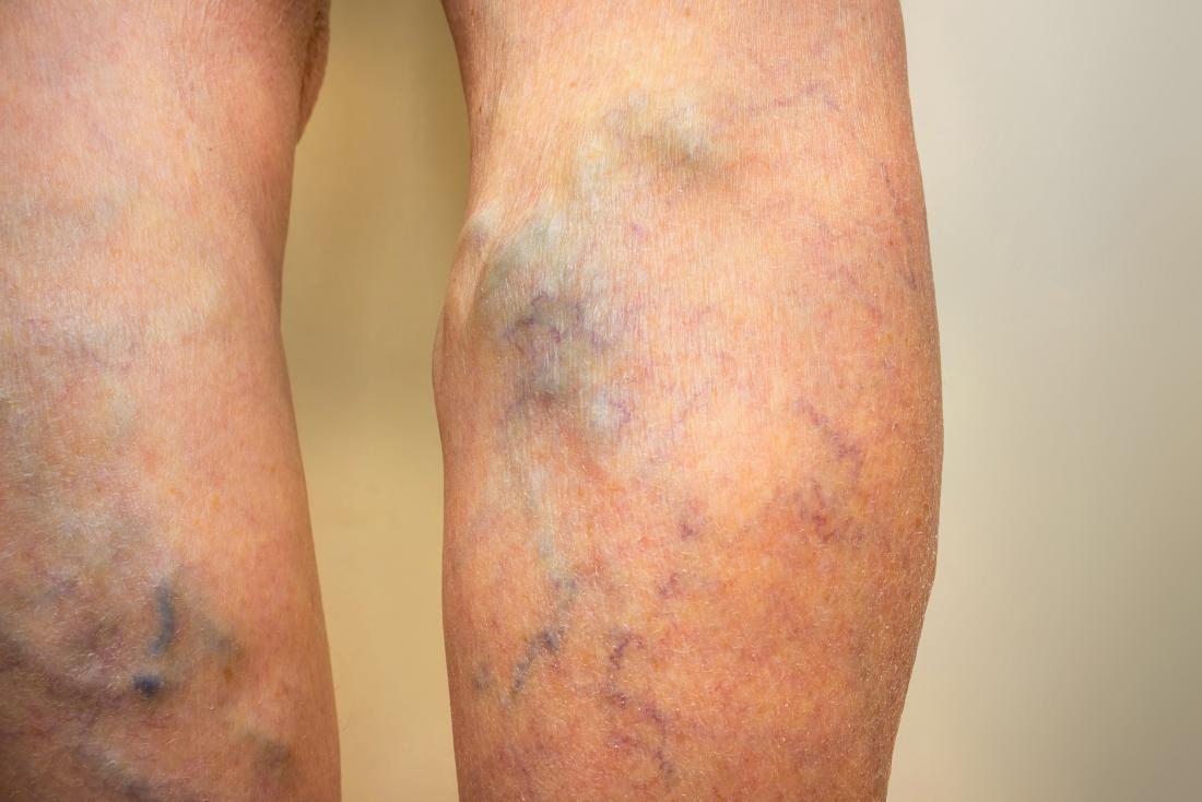 people-with-varicose-veins