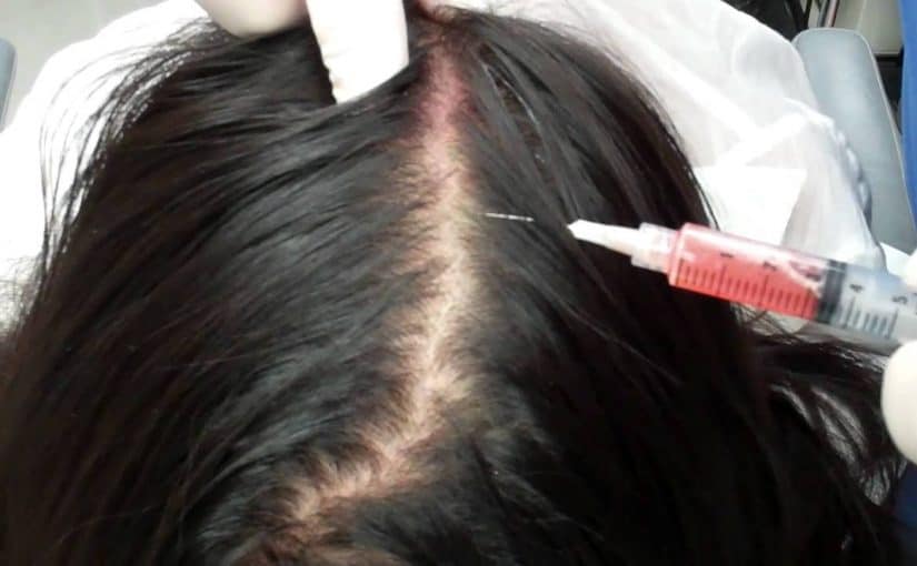 prp_hair_growth-825x510-2 سعر حقن البلازما للشعر في الرياض