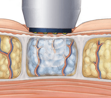 radiofrequency-2-380x335-1 13.ترددات الموجات اللاسلكية :