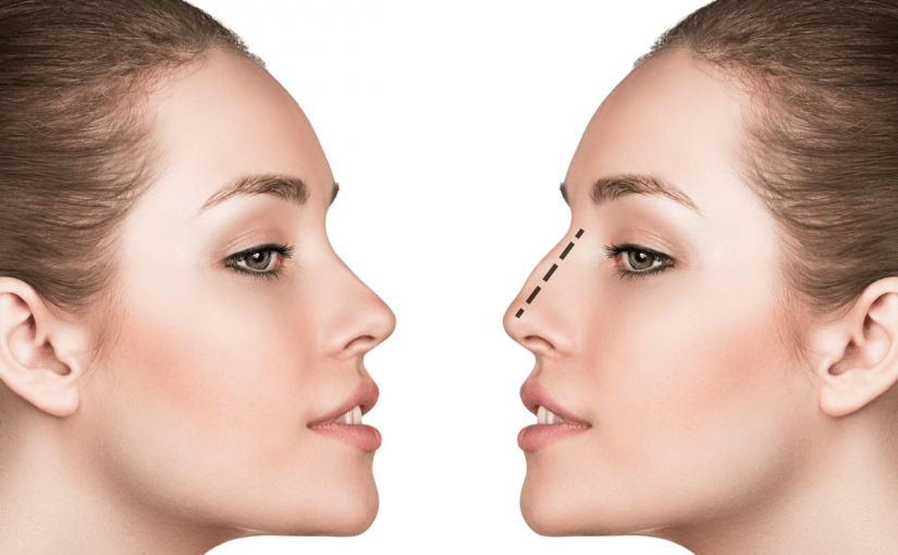 rinoplastie-chirurgie-estetica-nas-825x510-2 كل ما تحتاج لمعرفته عن إعادة تشكيل الأنف في دبي