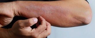 shutterstock_10662621832012 الحكة والاكزيما