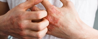 shutterstock_580580401202 اعراض الاكزيما