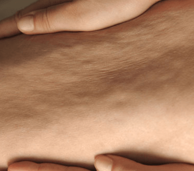 signs_of_cellulite-2-380x335-1 2.علامات السلوليت :