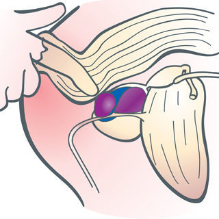 سرطان البروستاتا سرطان البروستاتا