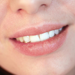 جفاف الفم جفاف الفم