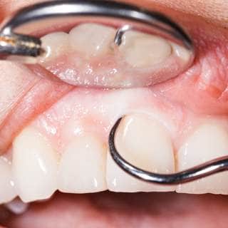 أمراض الأسنان وتراجع اللثة أمراض الأسنان وتراجع اللثة