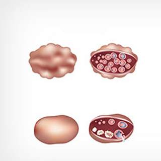 المبيض متعدد الكيسات