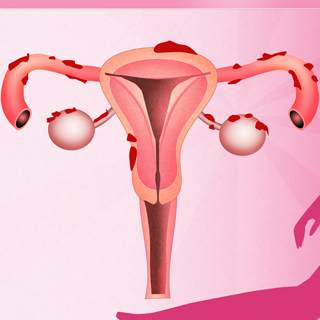 سرطان بطانة الرحم