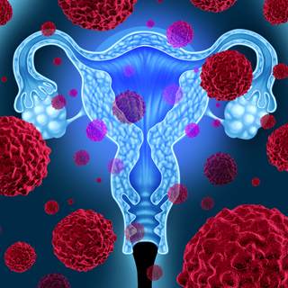 سرطان عنق الرحم