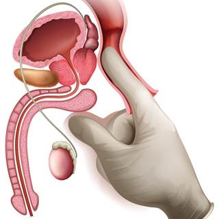 ما هو سرطان البروستاتا؟ ما هو سرطان البروستاتا؟