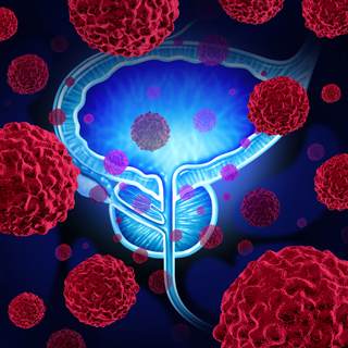 ما هي أسباب الإصابة بسرطان البروستاتا؟ ما هي أسباب الإصابة بسرطان البروستاتا؟
