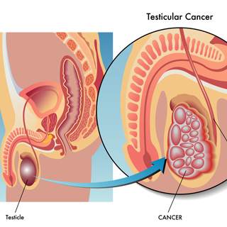 سرطان الخصيتين سرطان الخصيتين