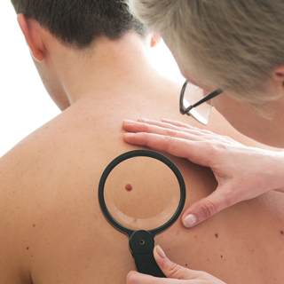 سرطان الجلد سرطان الجلد