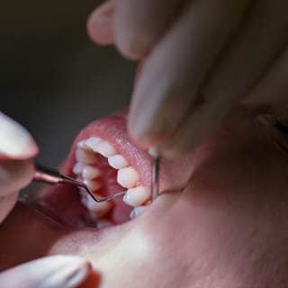 تراجع اللثة تراجع اللثة